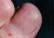 Telangiectases in the cuticle