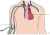 ingebrachte centrale catheter