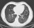 CTscan van een long met PAP.