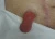Stomaprolaps 